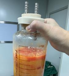 禹城水动力吸脂手术要做多久？